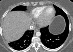 Inferior Vena Cava (IVC) Calcification - CTisus CT Scan