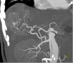 Hepatoma With Neovascularity - CTisus CT Scan