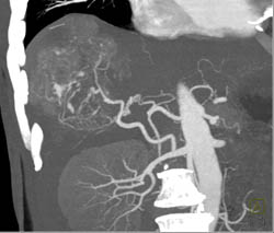 Hepatoma With Neovascularity - CTisus CT Scan