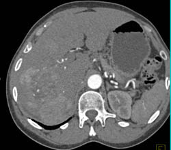 Hepatoma With Neovascularity - CTisus CT Scan