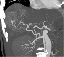 Hepatoma With Neovascularity - CTisus CT Scan