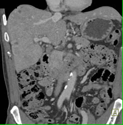 Hepatoma With Neovascularity - CTisus CT Scan