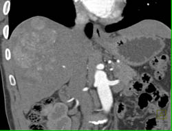 Hepatoma With Neovascularity - CTisus CT Scan