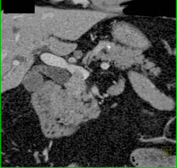 Pancreatic Mass Occludes and Invades Portal Vein - CTisus CT Scan