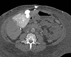 Hot Spot Liver Due to SVC Occlusion - CTisus CT Scan