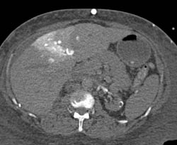 Hot Spot Liver Due to SVC Occlusion - CTisus CT Scan