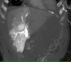 Hot Spot Liver Due to SVC Occlusion - CTisus CT Scan