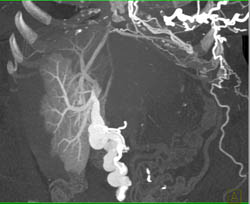 Hot Spot Liver Due to SVC Occlusion - CTisus CT Scan