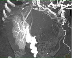 Hot Spot Liver Due to SVC Occlusion - CTisus CT Scan