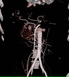 Hepatoma - CTisus CT Scan