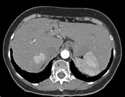 Hepatoma - CTisus CT Scan