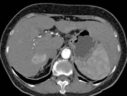 Hepatoma - CTisus CT Scan