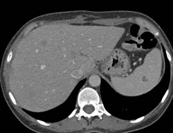 Liver and Splenic Abscesses- Fungal - CTisus CT Scan