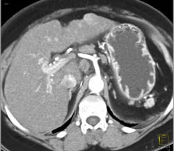 Cirrhosis With Subtle Hepatoma - CTisus CT Scan