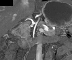 Splenic and Gastroduodenal Artery (GDA) Aneurysms - CTisus CT Scan