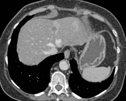 Fatty Liver - CTisus CT Scan