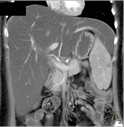 Fatty Liver - CTisus CT Scan