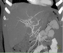 Hepatic Artery Occlusion With Web-like Collaterals - CTisus CT Scan