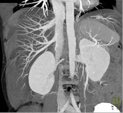 Variation of Venous Drainage Into IVC - CTisus CT Scan