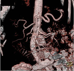 Hepatic Artery Mapping - CTisus CT Scan