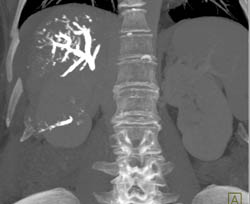 Embolization of Portal Vein - CTisus CT Scan