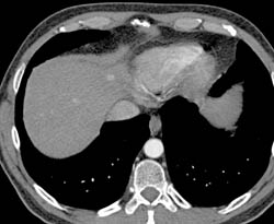 1 Cm Hemangioma - CTisus CT Scan