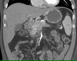 Sequence With Collaterals Near Head of Pancreas With Portal Vein/Superior Mesenteric Vein (SMV) Involvement - CTisus CT Scan