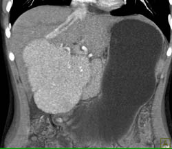 Giant Focal Nodular Hyperplasia (FNH) - CTisus CT Scan