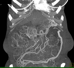 Cirrhosis With Huge Collateral Network - CTisus CT Scan