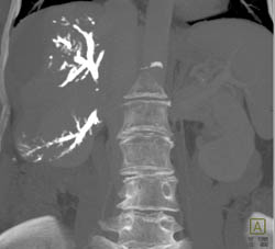 Portal Vein Embolization - CTisus CT Scan