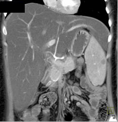 Fatty Liver - CTisus CT Scan