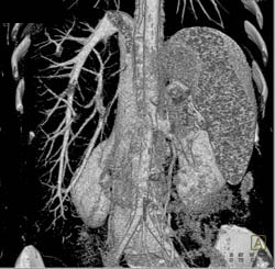 Fatty Liver - CTisus CT Scan