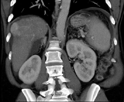 Hepatoma - CTisus CT Scan