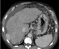 Hepatoma - CTisus CT Scan