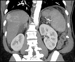 Hepatoma - CTisus CT Scan