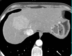 Focal Nodular Hyperplasia (FNH) With Full Vascular Sequence - CTisus CT Scan