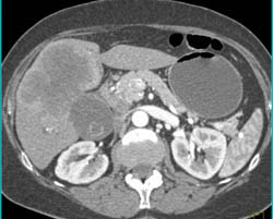 Cholangiocarcinoma Vs Gallbladder Cancer- Was Gallbladder Cancer - CTisus CT Scan