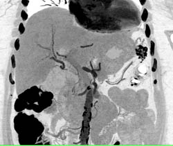 Ampullary Cancer - CTisus CT Scan