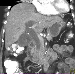 Ampullary Cancer - CTisus CT Scan