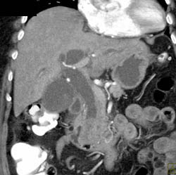 Ampullary Cancer - CTisus CT Scan