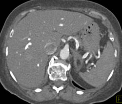 Reflux of Contrast Into IVC Due to Reflux - CTisus CT Scan