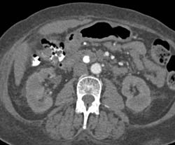 Choledochal Cyst S/P ERCP - CTisus CT Scan