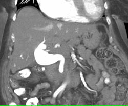 Cholangiocarcinoma of Distal Common Bile Duct With Enhancement - CTisus CT Scan