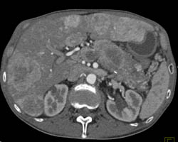 Metastatic Islet Cell Tumor Invades the Portal Vein and Occludes the Splenic Vein - CTisus CT Scan