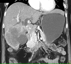 Invasive Gallbladder Cancer Invades the Portal Vein - CTisus CT Scan