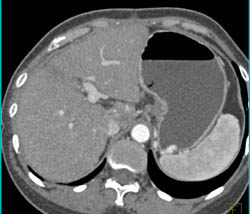 Hepatoma in Caudate Lobe in Cirrhotic Patient With Portal Hypertension - CTisus CT Scan