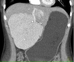 Focal Nodular Hyperplasia (FNH) in 11 Year Old Female - CTisus CT Scan