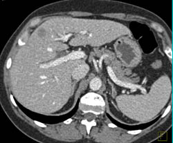 Hepatoma - CTisus CT Scan