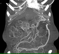 Impressive Collateral Due to Splenic Vein Occlusion By Pancreatic Cancer - CTisus CT Scan