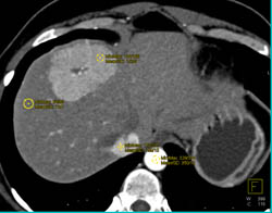 Focal Nodular Hyperplasia (FNH) - CTisus CT Scan